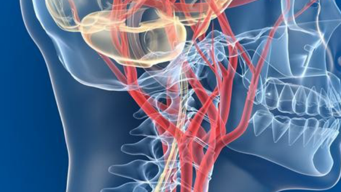 Гипоплазия позвоночной артерии. Патология позвоночной артерии. Гипоплазия левой позвоночной артерии. Гипоплазия v4 сегмента позвоночной артерии.