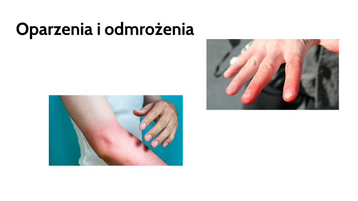 Oparzenia i odmrożenia by Valeriy Zhdanov on Prezi