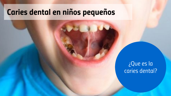 Caries dental en niños pequeños by Maria Fernanda Cadeza Maldonado