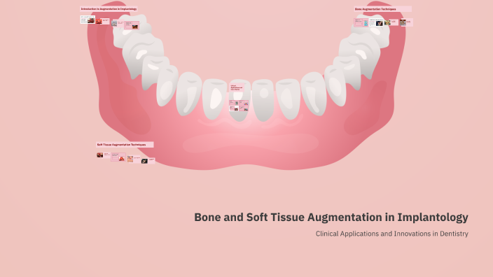 Bone and Soft Tissue Augmentation in Implantology by lames FOZY on Prezi