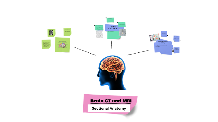 BRAIN CT AND MRI SECTIONAL ANATOMY by peach on Prezi
