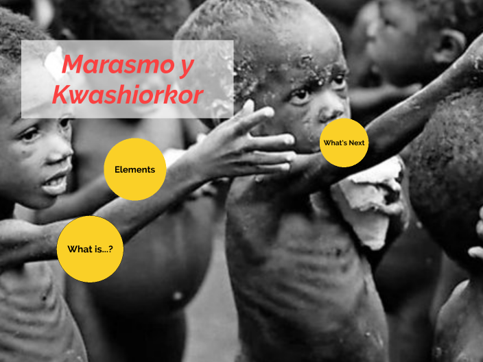 Marasmo Y Kwashiorkor By Jennifer Lopez