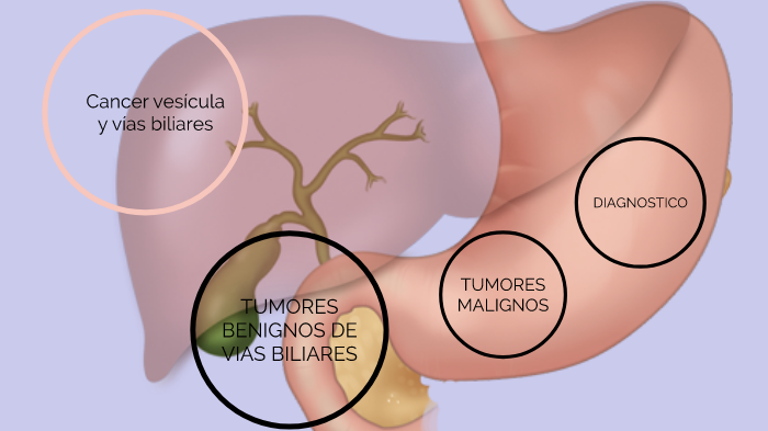 cáncer de las vías biliares