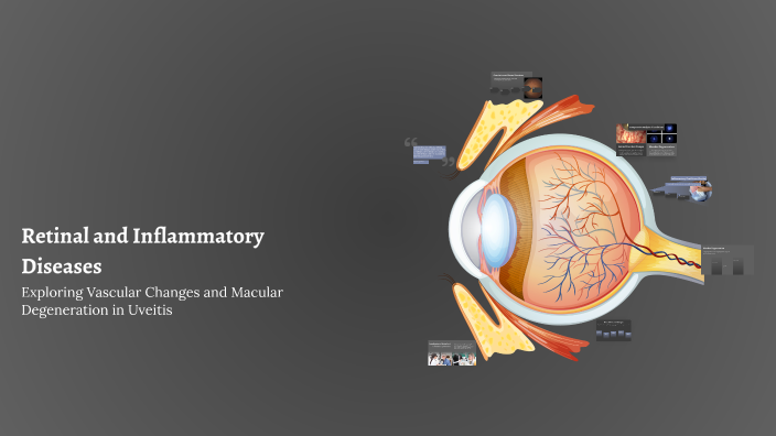 Retinal and Inflammatory Diseases by شيماء ساتة on Prezi