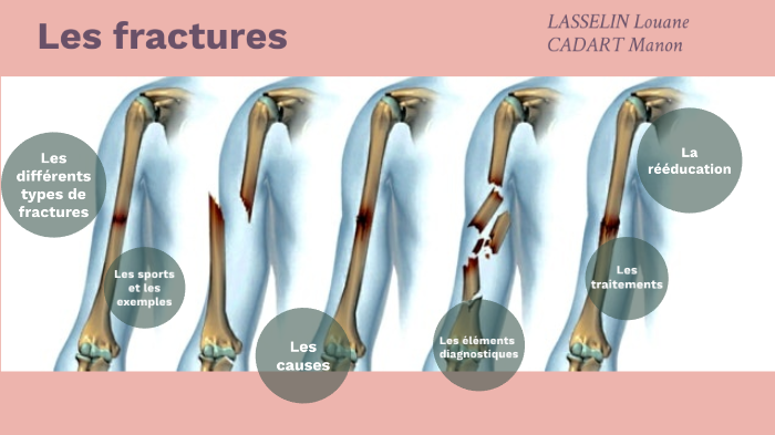 Fractures Fractures De Fatigue Ect By Manon Cadart On Prezi