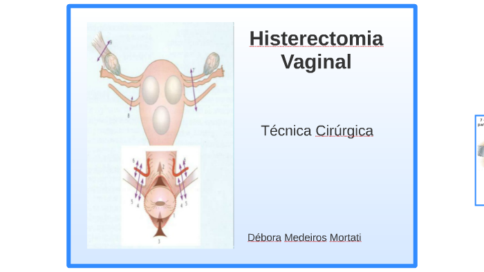 Histerectomia Vaginal By Guilherme Araujo Silva On Prezi 0277