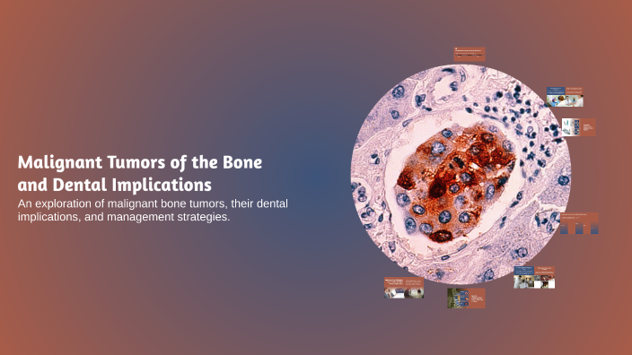 Malignant Tumors of the Bone and Dental Implications by Hased Nased on ...