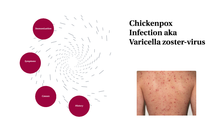 Chickenpox Analysis by Danielle Mauzy on Prezi