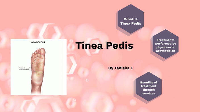 Treatment Principles For Tinea Pedis