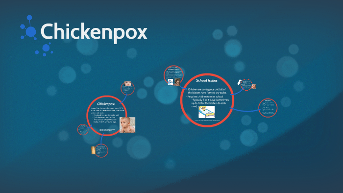 Chickenpox by Laura Kelly on Prezi