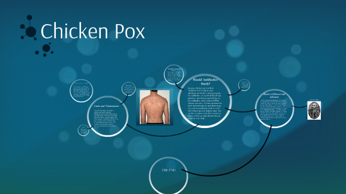 Chicken Pox by Ben Heyne on Prezi