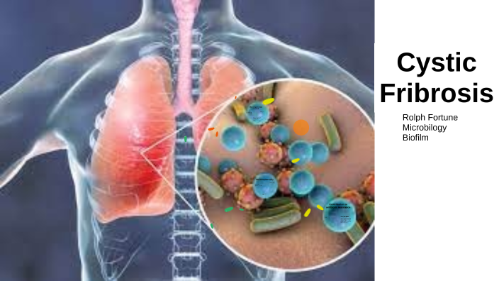 Cystic Fibrosis By Tom Fortune On Prezi cystic-fibrosis-by-tom-fortune-on-prezi