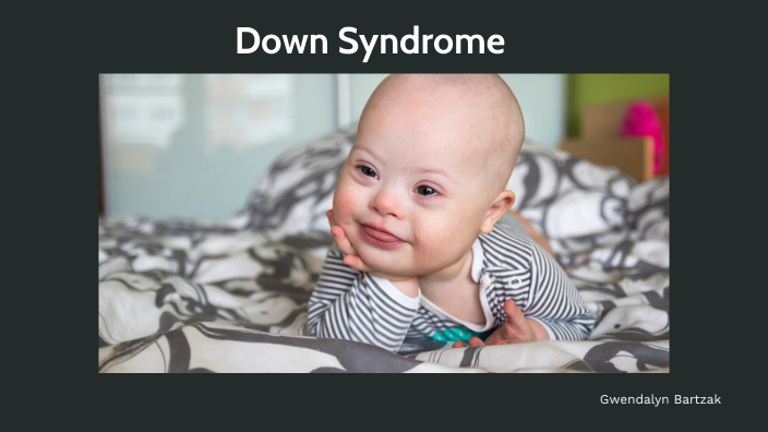 Down Syndrome by GWEN BARTZAK on Prezi