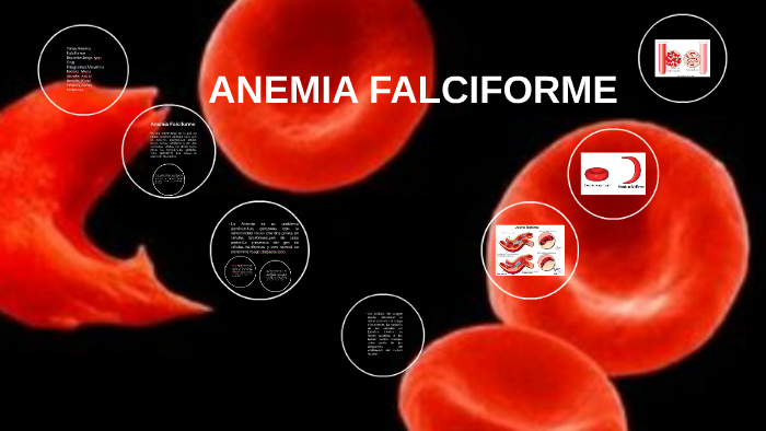 Anemia Falciforme By Camila Maturana 0408