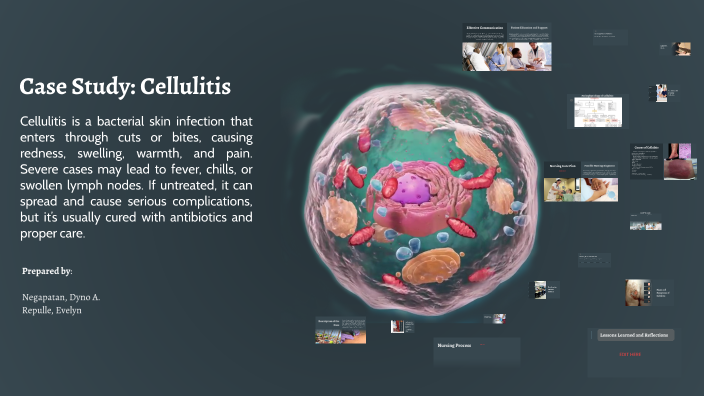 Case Study: Cellulitis by Dianne Negapatan on Prezi