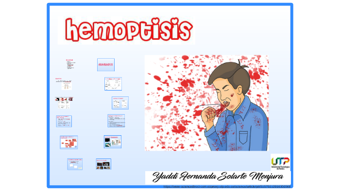 Hemoptisis