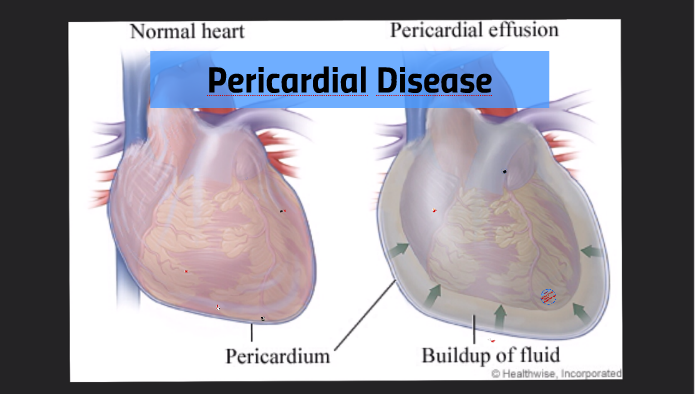 Pericardial Disease By Andrea Sadler On Prezi