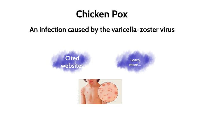 Chicken Pox by Kezia Shelin Arundavid Shelly on Prezi