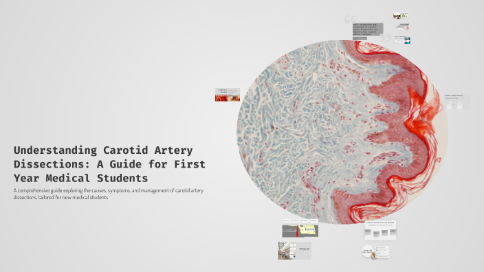 Understanding Carotid Artery Dissections: A Guide for First Year ...