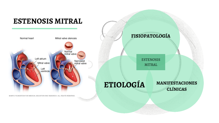 Fisiopatología de la estenosis de la válvula mitral