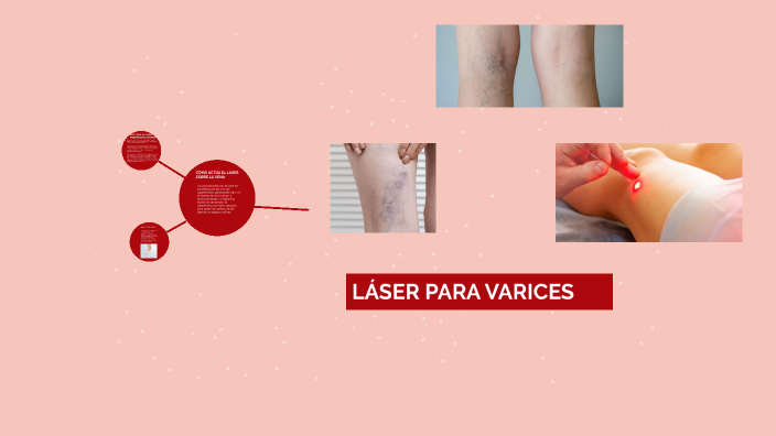 LASER PARA VARICES by marta bosch on Prezi