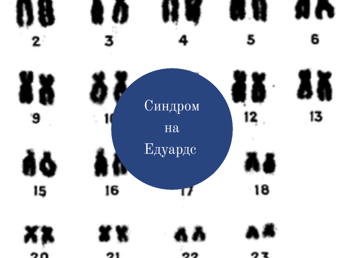 Синдром на Едуардс by beste berber on Prezi