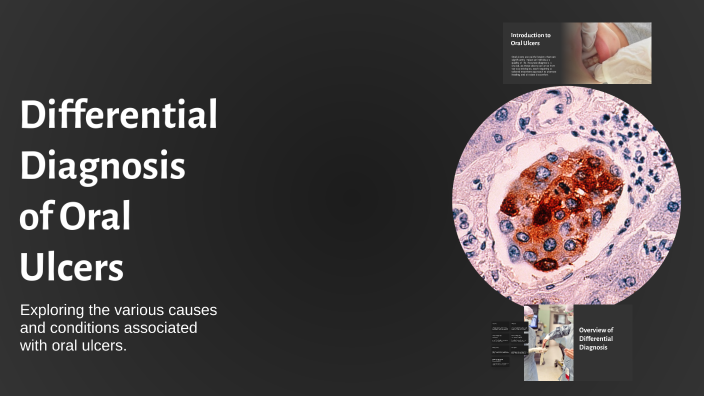 Differential Diagnosis of Oral Ulcers by Arwa Elsherif on Prezi
