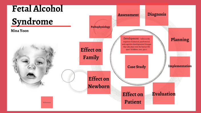 Fetal Alcohol Syndrome by Nina Y on Prezi