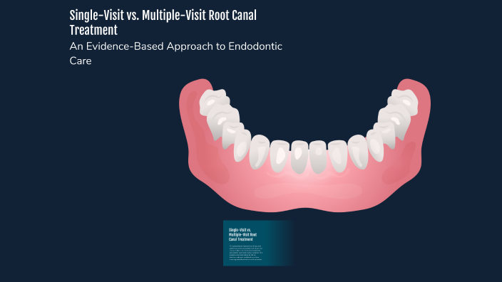 Multiple Visit Rct Single-Visit vs. Multiple-Visit Root Canal Treatment by Ω
ΨΩ
Ψ― on Prezi
