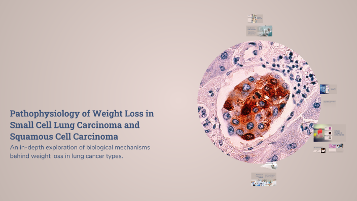 Pathophysiology of Weight Loss in Small Cell Lung Carcinoma and ...