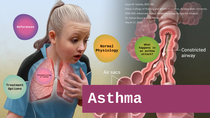 Asthma - Disease Presentation by Kayla Galetta, BSN, RN on Prezi