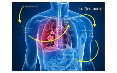 La Neumonia by on Prezi