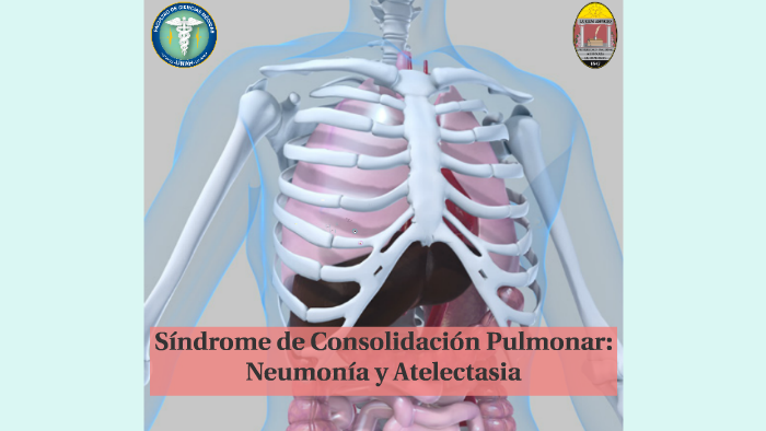 Síndrome de consolidación pulmonar by diana mejia on Prezi