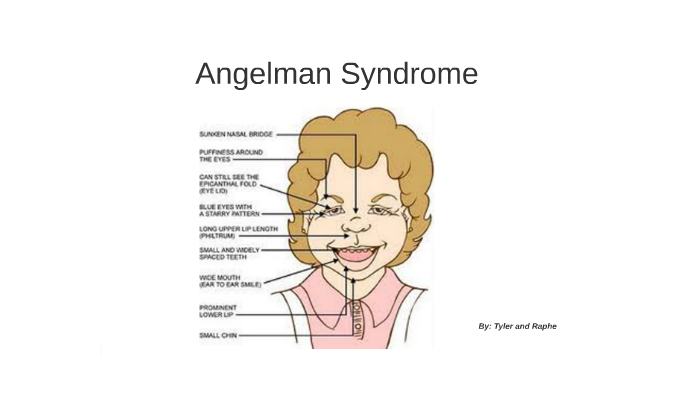 angelman syndrome baby symptoms
