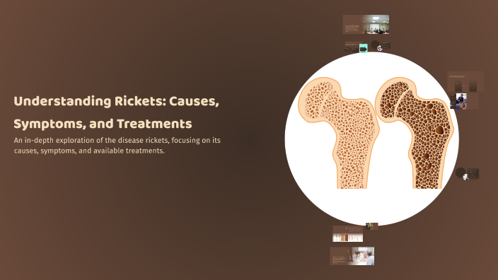Understanding Rickets: Causes, Symptoms, and Treatments by akylai ...