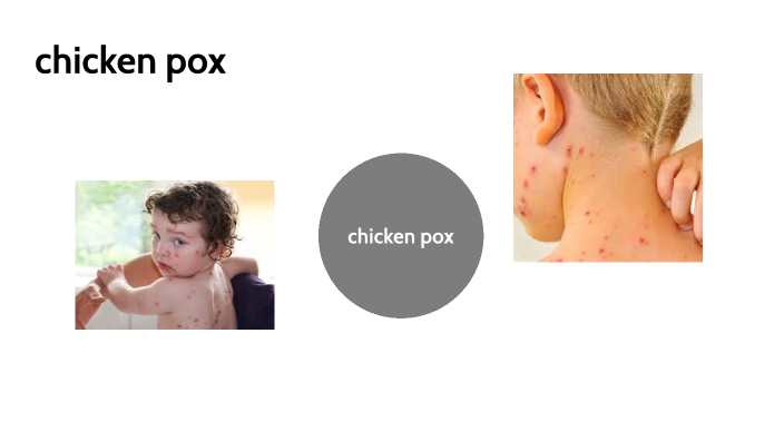 chicken pox by abdalla ismael on Prezi