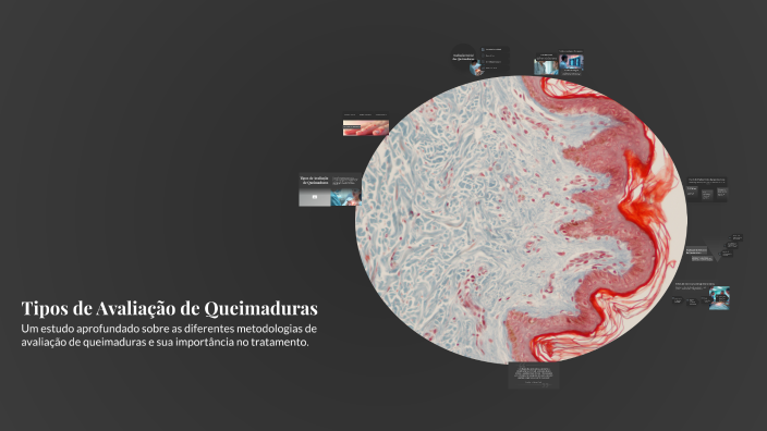 Tipos de Avaliação de Queimaduras by CAROLINA CHAGAS on Prezi