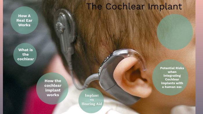 Cochlear Implants Lilly Dixon By Lilly Dixon