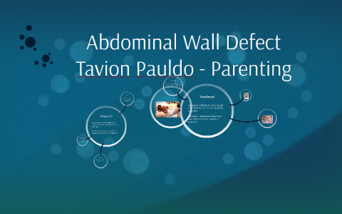 Abdominal Wall Defect by Tavion Pauldo on Prezi