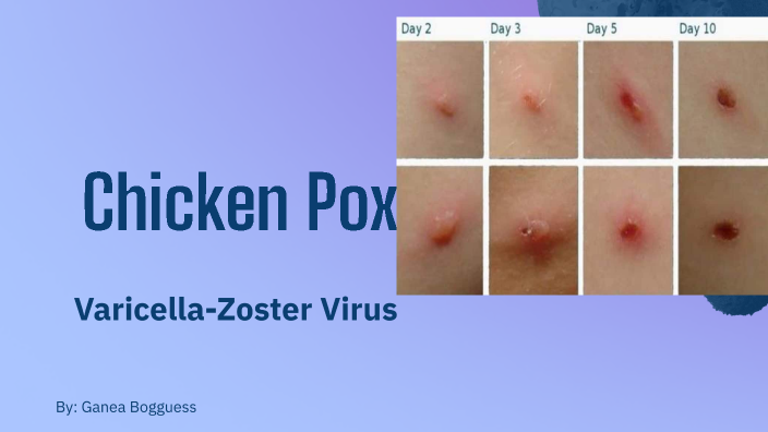 Chicken Pox by ganea bogguess on Prezi
