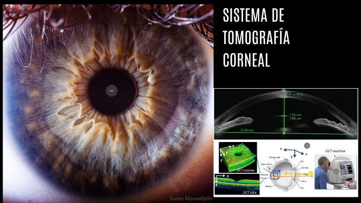 Sistemas De Tomografía Corneal By Sophie Sanchez On Prezi