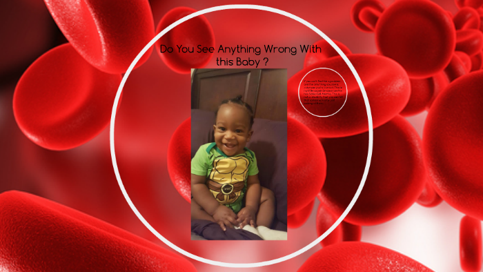 Sickle Cell Anemia by Kay White