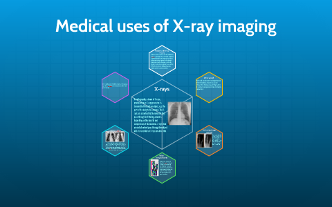 Medical Uses Of X-ray Images By Abhishek Bhavsar On Prezi Next