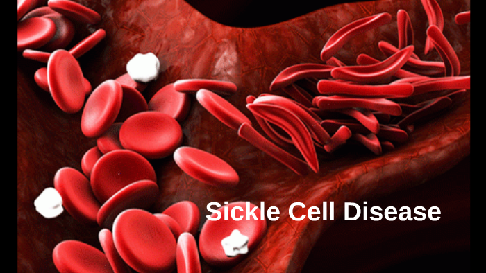 Sickle Cell Disease by Emma Reidy