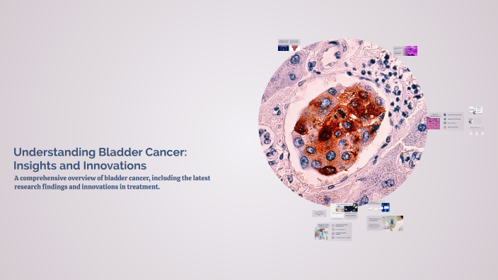 Understanding Bladder Cancer: Insights and Innovations by Temka ...