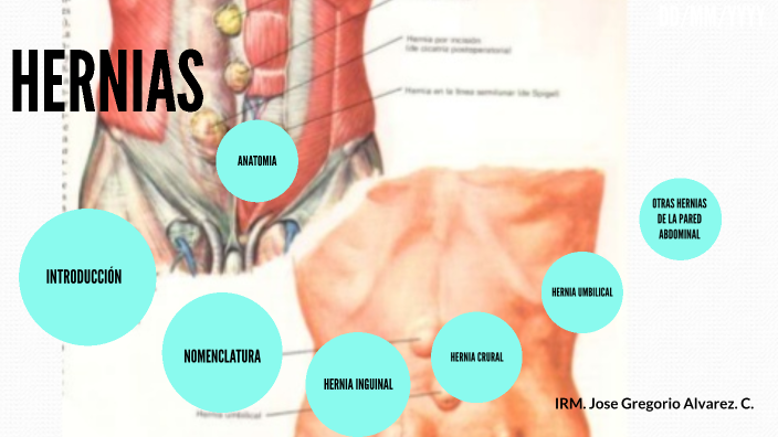 HERNIAS ABDOMINALES by Jose Gregorio Alvarez Curillo on Prezi