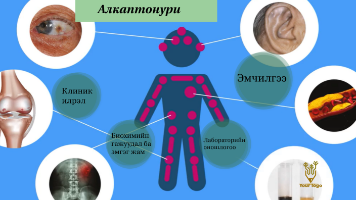 Алкаптонури by Сүхбаатар Цэрэнлхам on Prezi