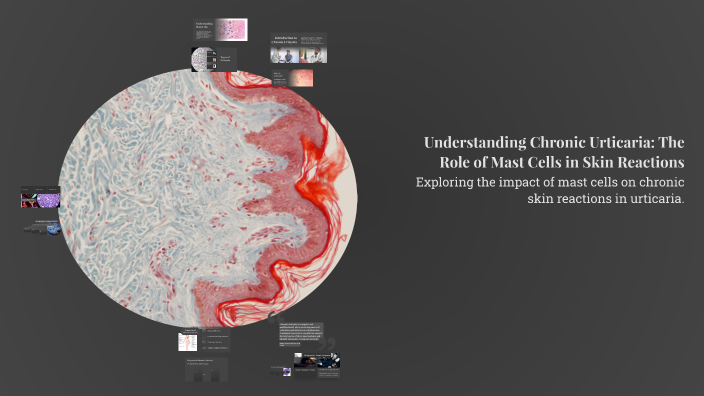 Understanding Chronic Urticaria: The Role of Mast Cells in Skin ...