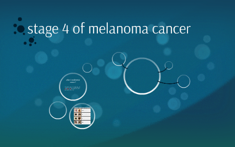 stage 4 of melanoma cancer by on Prezi