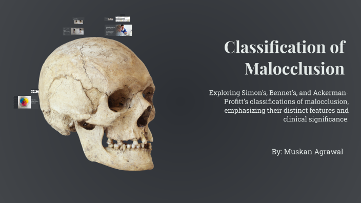 Classification of Malocclusion by Aditi Badage on Prezi